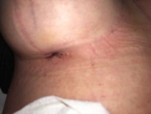 Vết rạch ở ngực của tôi liệu có cần kháng sinh không?