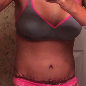 Rốn của tôi trông thật kinh khủng 5 ngày sau phẫu thuật, có phải đã bị hoại tử rồi không?