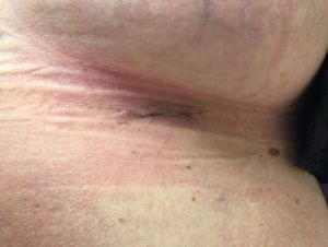 Vết rạch ở ngực của tôi liệu có cần kháng sinh không?