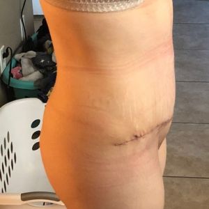 Tại sao trông tôi không giống như lúc mới làm phẫu thuật combo ngực bụng?