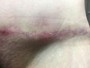 Nổi cục cứng to ở dưới da sau tạo hình thành bụng: là sẹo hay nhiễm trùng?