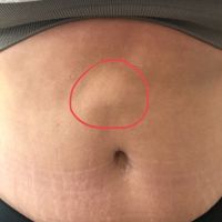 Đã làm combo ngực bụng được một năm, bụng có cục lồi trông như bị thoát vị mà không có dịch, có bình thường hay không?