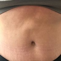 Đã làm combo ngực bụng được một năm, bụng có cục lồi trông như bị thoát vị mà không có dịch, có bình thường hay không?