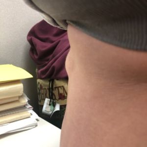 Đã làm combo ngực bụng được một năm, bụng có cục lồi trông như bị thoát vị mà không có dịch, có bình thường hay không?