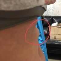 Đã làm combo ngực bụng được một năm, bụng có cục lồi trông như bị thoát vị mà không có dịch, có bình thường hay không?