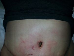 Tôi đang bị nhiễm trùng loại nào vậy?