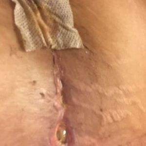 Vết mổ của tôi trông có bình thường không, có lành được không?