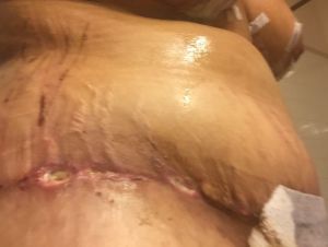 Vết mổ của tôi trông có bình thường không, có lành được không?