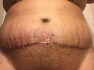 Vết mổ của tôi trông có bình thường không, có lành được không?