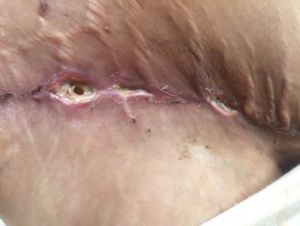 Vết mổ của tôi trông có bình thường không, có lành được không?