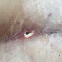 Vết mổ của tôi trông có bình thường không, có lành được không?