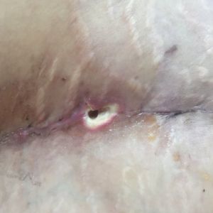 Vết mổ của tôi trông có bình thường không, có lành được không?