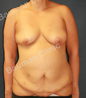 Combo ngực bụng Mommy Makerover, khách hàng Mỹ - Case 1
