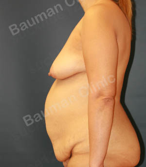 Combo ngực bụng Mommy Makerover, khách hàng Mỹ - Case 1