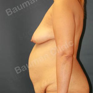 Combo ngực bụng Mommy Makerover, khách hàng Mỹ - Case 1