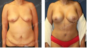 Combo ngực bụng Mommy Makerover, khách hàng Mỹ - Case 1