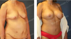 Combo ngực bụng Mommy Makerover, khách hàng Mỹ - Case 1