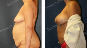 Combo ngực bụng Mommy Makerover, khách hàng Mỹ - Case 1