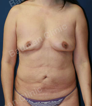 Combo ngực bụng Mommy Makeover, nữ 48 tuổi người Hàn Quốc - case 2