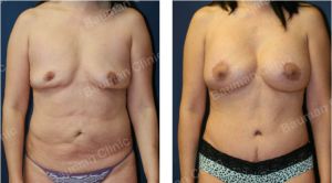 Combo ngực bụng Mommy Makeover, nữ 48 tuổi người Hàn Quốc - case 2