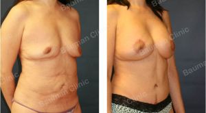 Combo ngực bụng Mommy Makeover, nữ 48 tuổi người Hàn Quốc - case 2