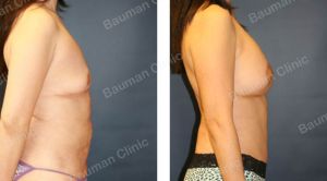 Combo ngực bụng Mommy Makeover, nữ 48 tuổi người Hàn Quốc - case 2