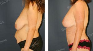 Combo ngực bụng Mommy Makeover,  khách hàng Mỹ - case 3