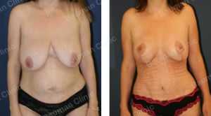 Combo ngực bụng Mommy Makeover,  khách hàng Mỹ - case 3