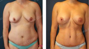 Combo ngực bụng, khách hàng Mỹ - case 4