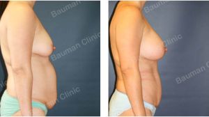 Combo ngực bụng, khách hàng Mỹ - case 4