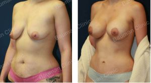 Combo ngực bụng Mommy Makeover, khách hàng nữ 27 tuổi người Mỹ - case 5