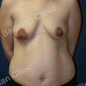 Combo ngực bụng Mommy Makeover, khách hàng Mỹ - case 7