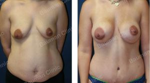 Combo ngực bụng Mommy Makeover, khách hàng Mỹ - case 7