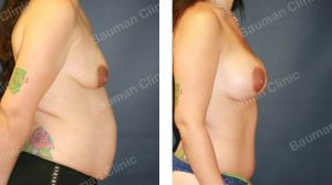 Combo ngực bụng Mommy Makeover, khách hàng Mỹ - case 7