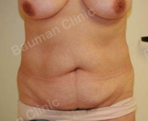 Combo ngực bụng Mommy Makeover, khách hàng nữ người Mỹ - case 8