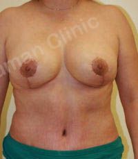 Combo ngực bụng Mommy Makeover, khách hàng nữ người Mỹ - case 8