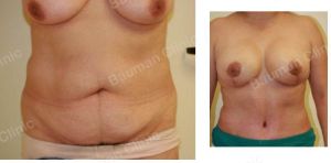 Combo ngực bụng Mommy Makeover, khách hàng nữ người Mỹ - case 8