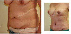 Combo ngực bụng Mommy Makeover, khách hàng nữ người Mỹ - case 8