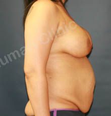 Combo ngực bụng Mommy Makeover chỉnh sửa thẩm mỹ hỏng, khách Mỹ - case 9