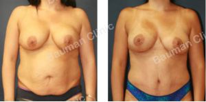 Combo ngực bụng Mommy Makeover chỉnh sửa thẩm mỹ hỏng, khách Mỹ - case 9