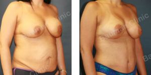 Combo ngực bụng Mommy Makeover chỉnh sửa thẩm mỹ hỏng, khách Mỹ - case 9