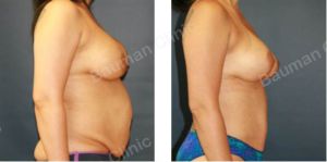 Combo ngực bụng Mommy Makeover chỉnh sửa thẩm mỹ hỏng, khách Mỹ - case 9