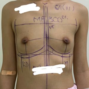 Chân ngực và mô trên 2 ngực không cân đối nhau.