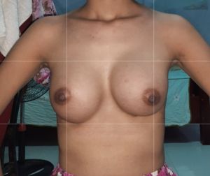 Chân ngực và mô trên 2 ngực không cân đối nhau.