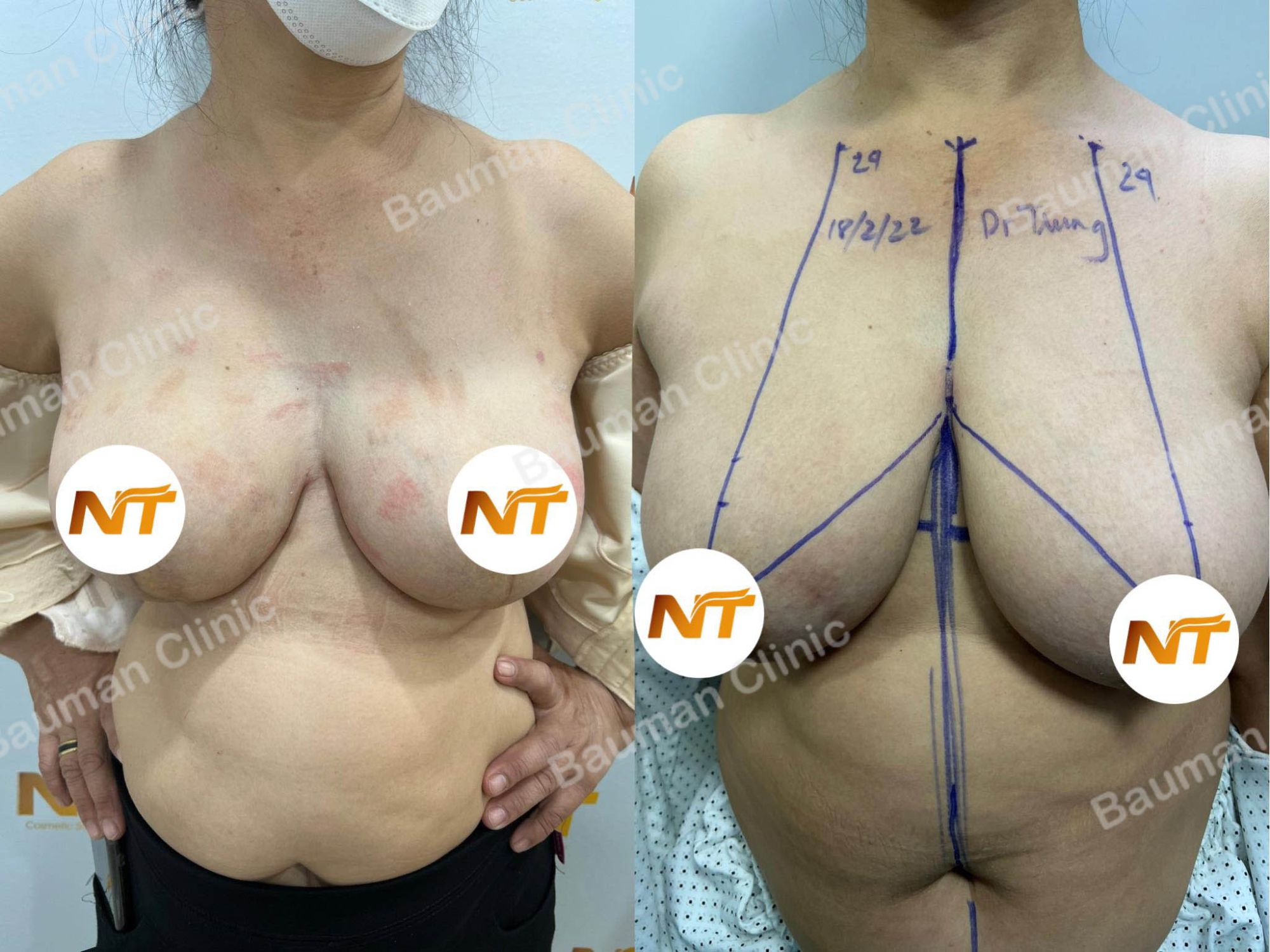 Thu nhỏ ngực phì đại, nữ 55 tuổi Hà Nội - case 50