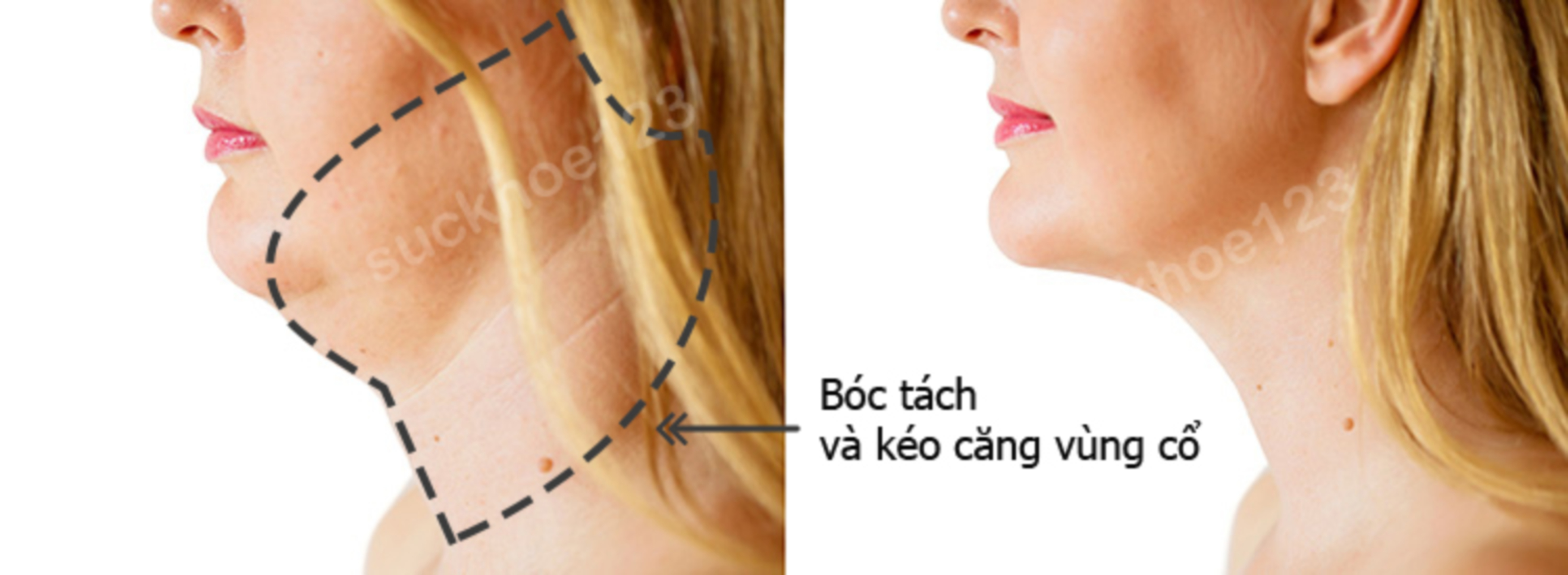 căng da cổ