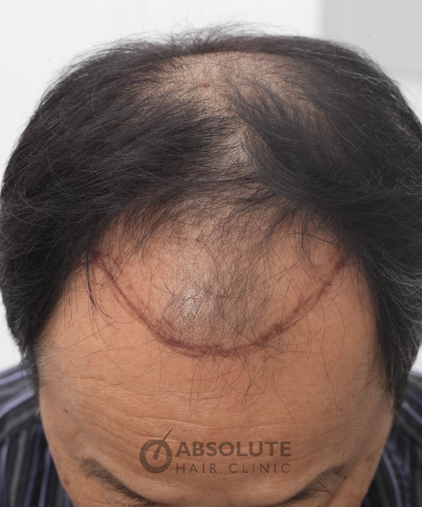 Cấy tóc FUE 1900 nang tóc, kết quả sau 16 tháng - case 10