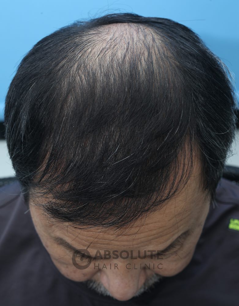 Cấy tóc FUE 1900 nang tóc, kết quả sau 16 tháng - case 10