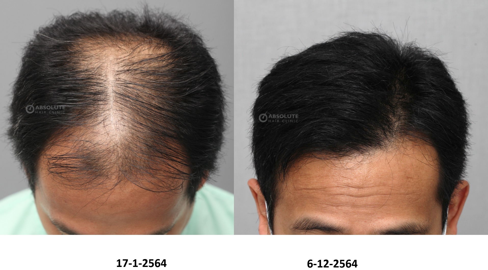 Cấy tóc FUE 3770 nang tóc, kết quả sau 11 tháng - case 101