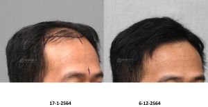 Cấy tóc FUE 3770 nang tóc, kết quả sau 11 tháng - case 101